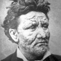 Norwegian leprosy patient