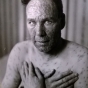 Black and white photograph of an adult male smallpox victim taken c.1924.