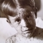 Black and white photograph of a juvenile male smallpox victim taken c.1900.