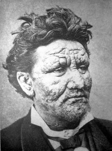 Norwegian leprosy patient