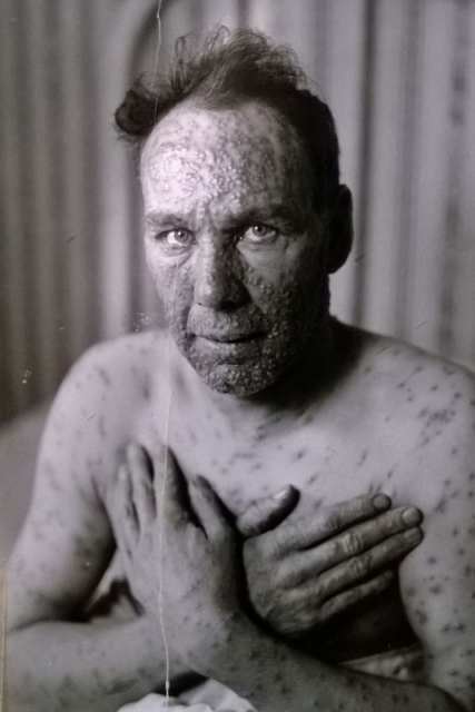 Adult male smallpox victim | MNopedia
