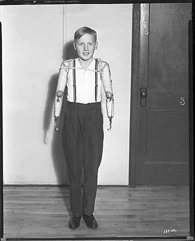 Black and white photograph of a boy with artificial arms, 1941. 
