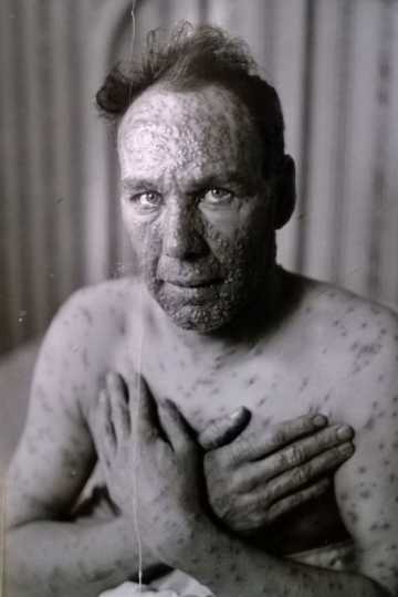 Black and white photograph of an adult male smallpox victim taken c.1924.