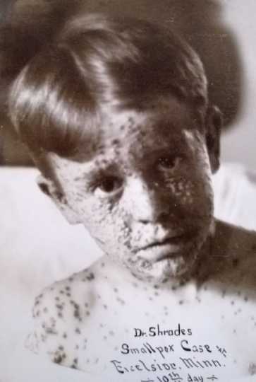 Black and white photograph of a juvenile male smallpox victim taken c.1900.