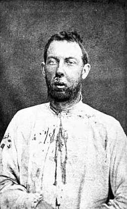 Black and white photograph of Jim Younger after being captured, September 1876. His face and shirt are bloody from a bullet wound in his jaw he received during the shoot out outside Madelia.  Photographed by Jacoby’s Art Gallery.
