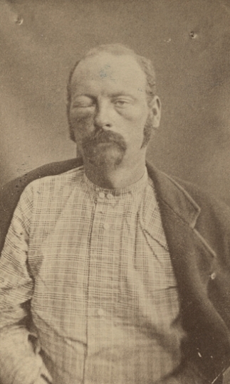 Black and white photograph of Cole Younger after being captured, September 1876. Younger’s face is swollen from a bullet wound he received during the shoot out outside Madelia. Photographed by Jacoby’s Art Gallery.